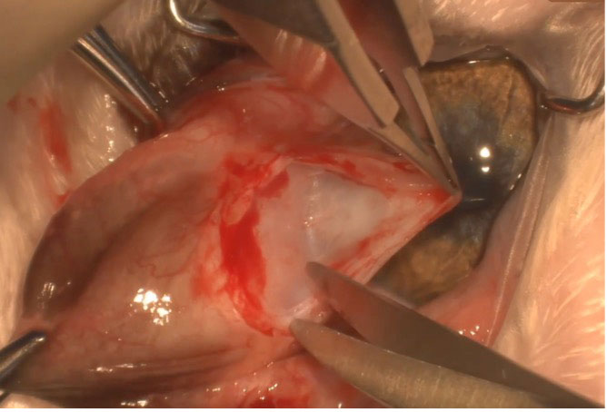 Figure 5. The creation of a deep conjunctival pocket by blunt dissection.