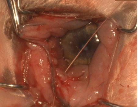 Figure 6b. 6-0 polyglactin absorbable suture being placed in a simple continuous fashion to distal along the conjunctival incision.