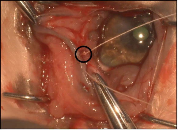 Figure 7: A single simple interrupted suture is placed to appose the centre of the two conjunctival incisions, maintaining the gland in a reduced position and facilitating placement of the simple continuous suture.
