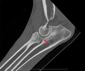 Figure 1. Sagittal reconstruction of CT images of the elbow of a Labrador retriever, showing a small step consistent with mild radioulnar incongruity (red arrow).