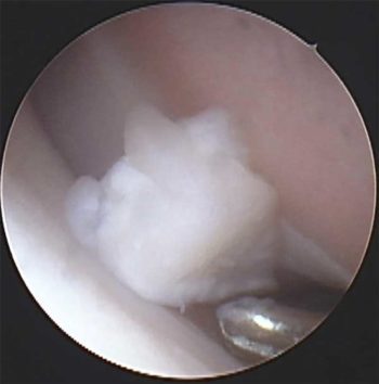 Figure 5. Arthroscopic view via standard medial approach demonstrating pink irregular worn cartilage in the medial compartment and white shiny cartilage in the lateral compartment. Note probe in the joint, freeing up a loose fragment of the medial coronoid process.
