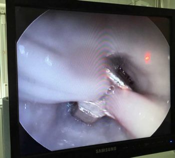 Figure 2. Endoscopic view of the zip as an oesophageal foreign body.