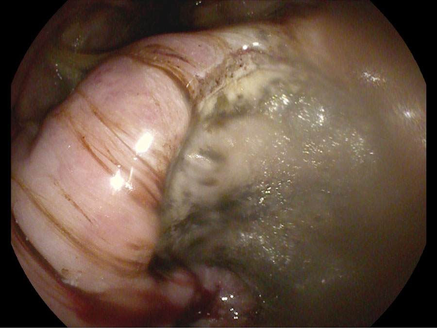 Figure 2. Ulcer revealed on the thickening of the lesser curvature in the nine-year-old Labrador retriever.