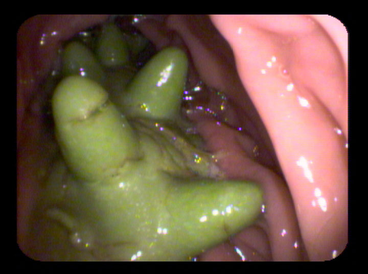 Figure 3. Foreign body revealed during endoscopy. 