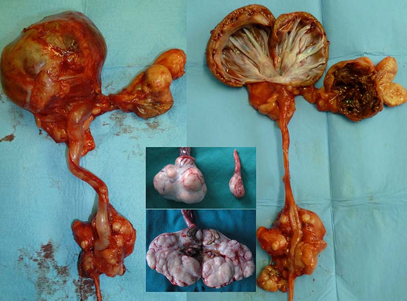 Figure 3. Ureteral obstruction with hydroureter and hydronephrosis secondary to metastatic to the renal and paraortic lymphnodes. Inset: testicular sertolioma.