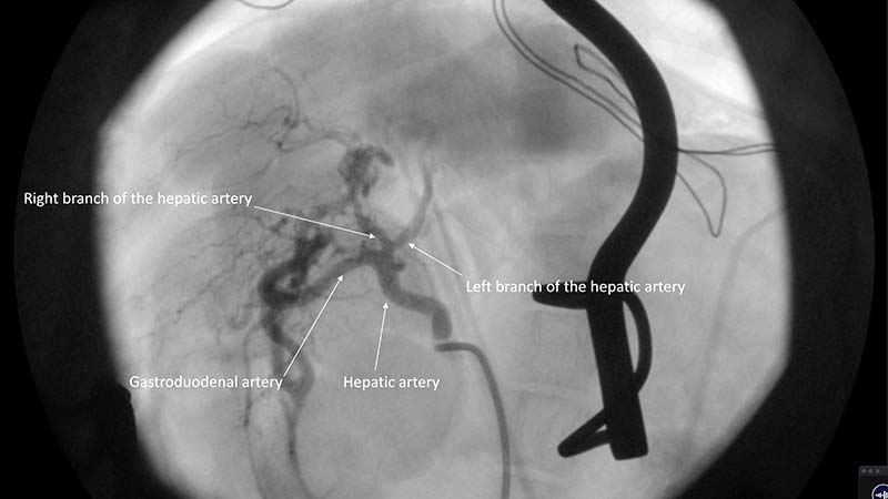 Figure 8. Digital subtraction selective angiography of the hepatic artery in a ventrodorsal projection. The head is to the top of each image.