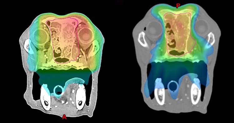 Figure 5. A conventional radiation plan for a nasal tumour on the left. Note that much of both eyes are in the high‑dose area. With intensity-modulated radiation therapy, both eyes can be spared from the high‑dose region, which reduces both long-term and short-term ocular adverse effects.
