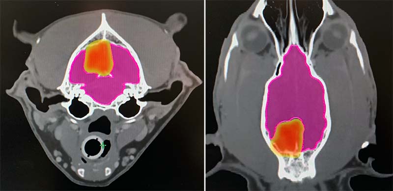 Figure 6. A transverse (6a; left) and coronal (6b; right) slice of a brain tumour treated with stereotactic radiation. The radiation dose is shown as a dose colour wash, with the red being the high‑dose region and the yellow being a rapid fall-off of dose outside the tumour. Note that hardly any normal brain 2mm outside the tumour (pink outline) is inside the high‑dose region.