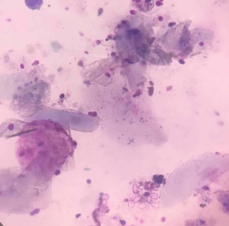 Figure 3. Cytology showing snowshoe-shaped Malassezia pachydermatis and cocci.