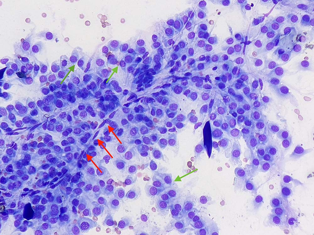 Figure 1. Left hindleg skin mass in a dog (Wright-Giemsa 50×).