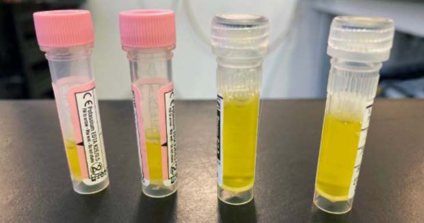 Figure 1. Typical straw-coloured FIP fluid obtained via thoracocentesis.