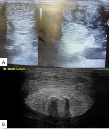 Figure 4a (top). Comparative ultrasound showing the superficial digital flexor tendon lesion in the right of the image and the normal contralateral limb on the left. Figure 4b. A deep digital flexor tendon lesion on ultrasound.
