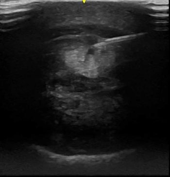 Figure 6. Ultrasound-guided intralesional injection of a core lesion.