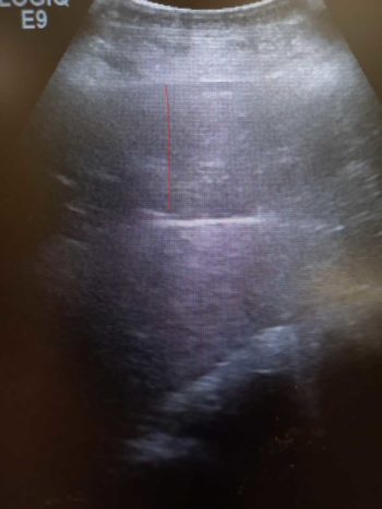 Figure 4. Horse with internal accumulation of fat (marked by red line) visible on ultrasound examination of the ventral midline.