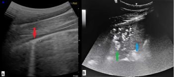 Figure 1a. Ultrasonographic image collected over the right mid lung field – dorsal is to the left of the image. The red arrow demonstrates a pleural surface irregularity leading to an associated artefact. These can be seen in cases with bacterial pneumonia, but can also be present due to any process that leads to a change in lung tissue density, for example, fibrosis, or neoplasia. Figure 1b. Ultrasonographic image collected over the right cranioventral lung field. Dorsal is to the left of the image. Severe bacterial pleuropneumonia is demonstrated here. The blue arrow demonstrates lung parenchymal consolidation, and the green arrow demonstrates air trapping among the consolidated tissue.