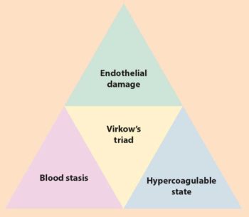 Figure 2. A graphic representation of Virkow’s triad. This suggests three contributing factors are in a thrombotic event: blood stasis, vessel wall injury and hypercoagulability.