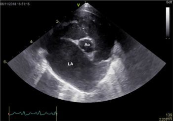 Figure 5. A right parasternal short axis view at the level of the aorta in a cat with marked left atrial dilation. Ao = aorta, LA = left atrium.