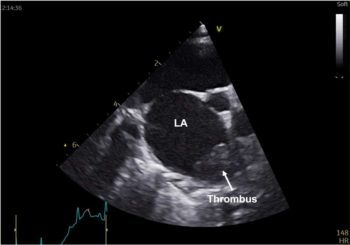 Figure 6. A modified right parasternal short axis view at the level of the aorta in a cat with marked left atrial dilation and a thrombus in the left atrial appendage. LA = left atrium.