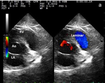 Figure 4a. Echocardiographic images of a dynamic right ventricular outflow tract obstruction caused by provocative testing. All images were obtained from the right parasternal short axis view at the level of the heart base. 4a. Normal laminar flow (Laminar) observed during systole in the right ventricle (RV) outflow tract prior to the manoeuvre.