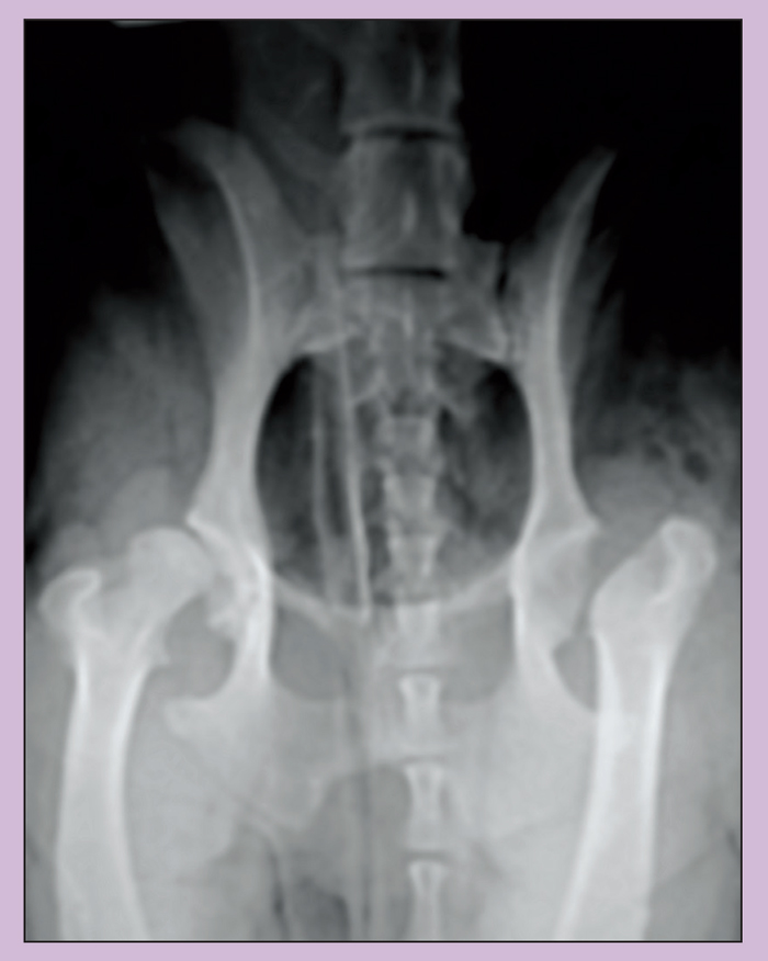 Femoral Head And Neck Excision